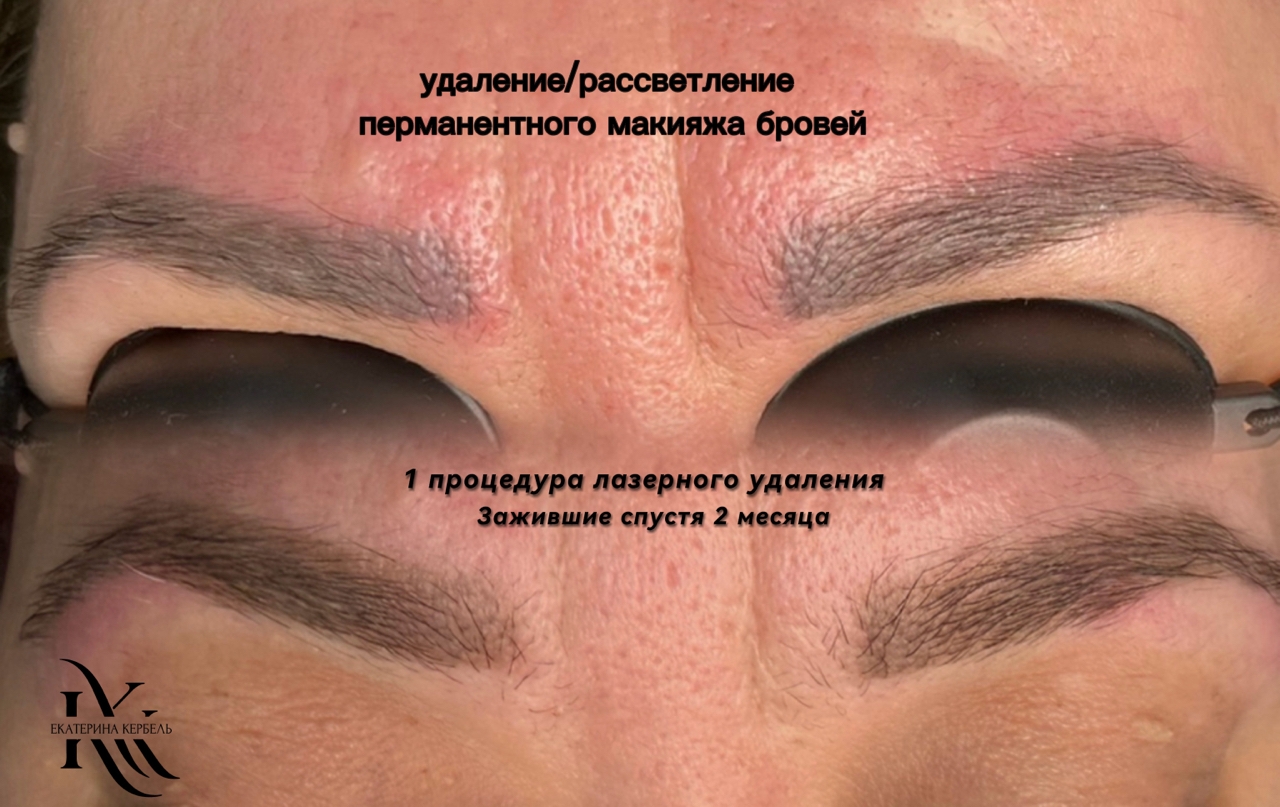 Лазерное удаление